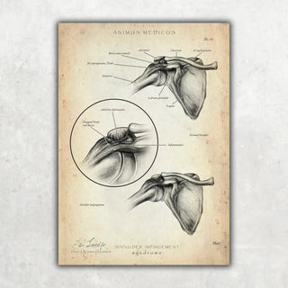 Animus Medicus Schulter Impingement – A1