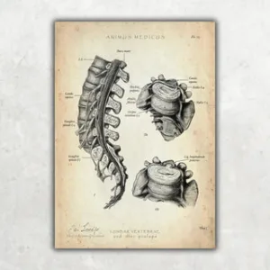 Animus Medicus Anatomie Poster Bandscheibenvorfall – A1