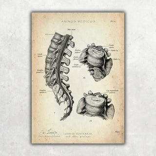 Animus Medicus Anatomie Poster Bandscheibenvorfall – A2